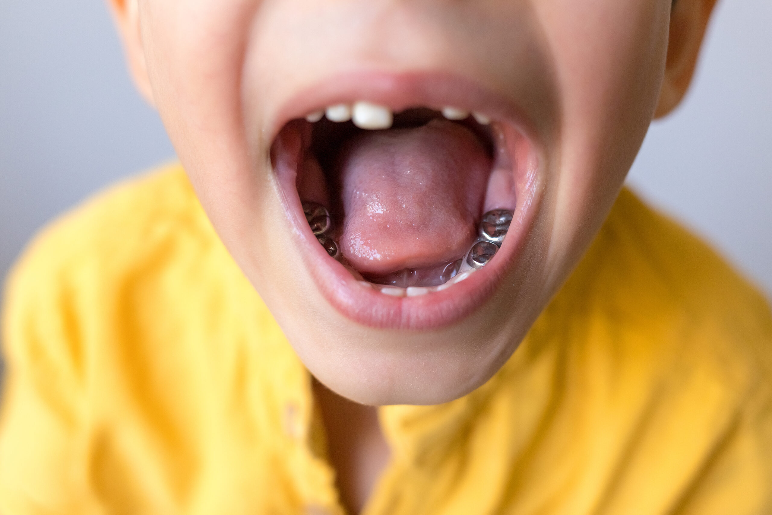 Dental care concept. Stainless steel crown a silver cap used for restoring children's teeth