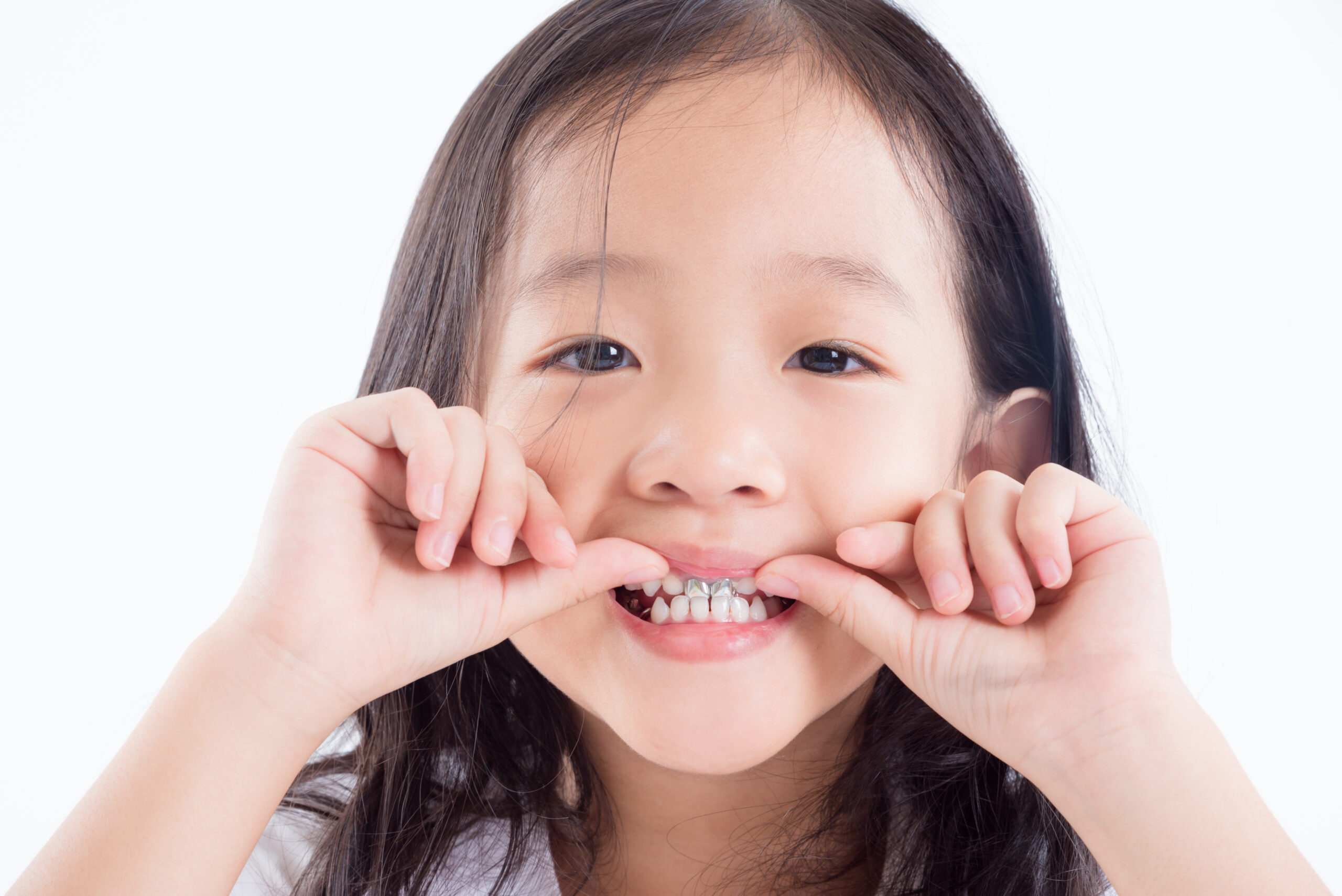 Young Asian girl child showing silver amalgam tooth sealant over white background