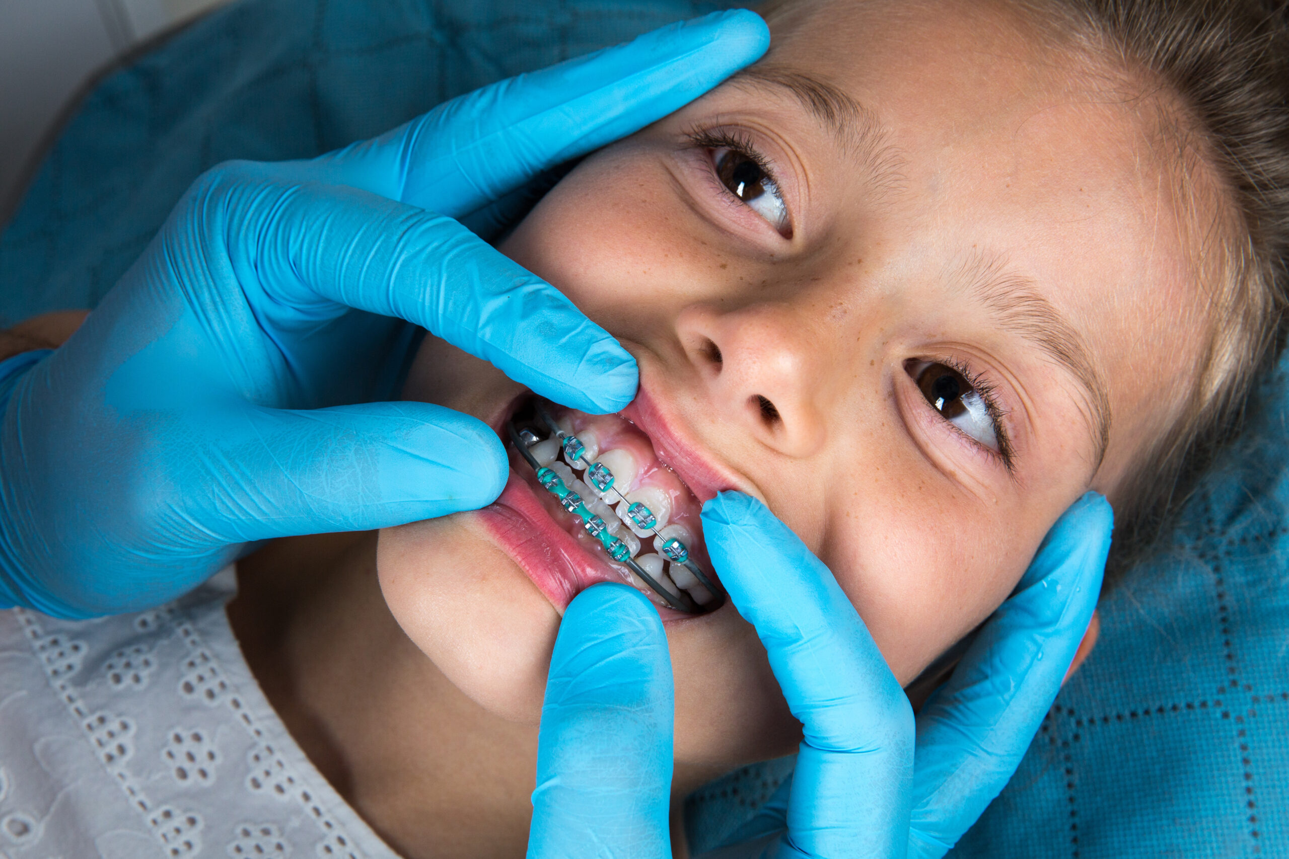Dentist, Orthodontist examining a little girl patient's teeth with green braces. Close up of girl head and dentist, orthodontist hands with blue gloves